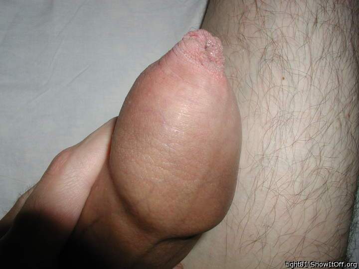 Phimosis
