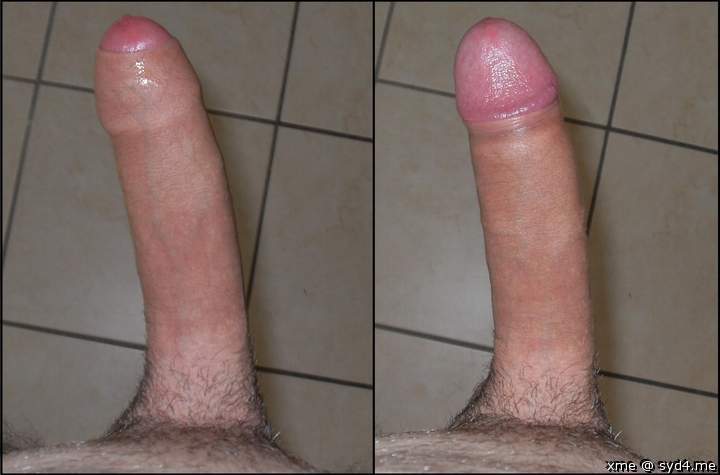 my foreskin