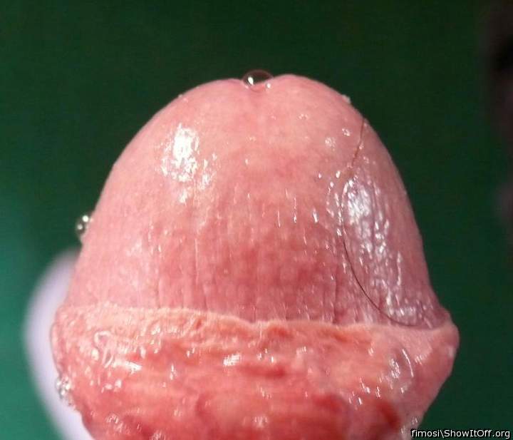 Foreskin glued to the glans
