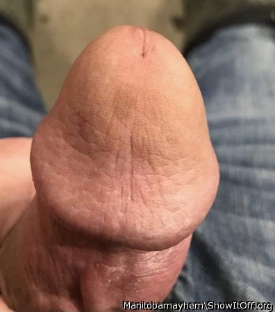 Birthmark on my glans
