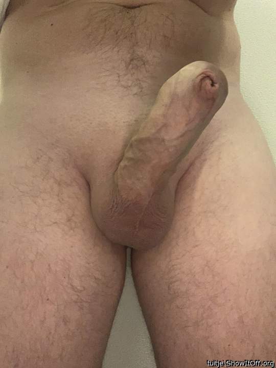Phimosis