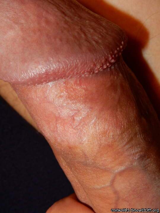 Pearly papules