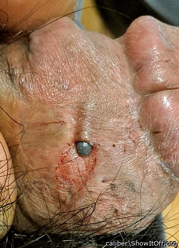 implant