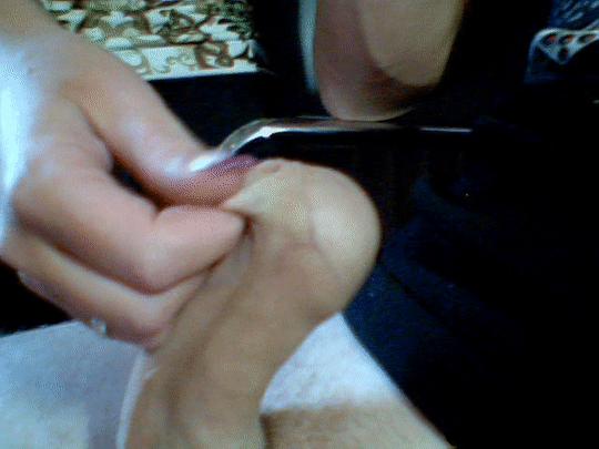Phimosis play
