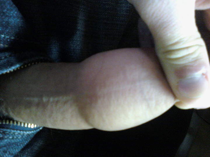 Foreskin Inflated