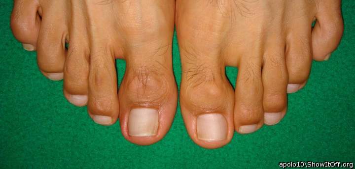 Toes apolo10