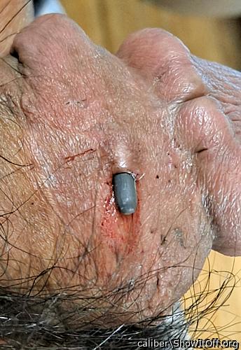 implant