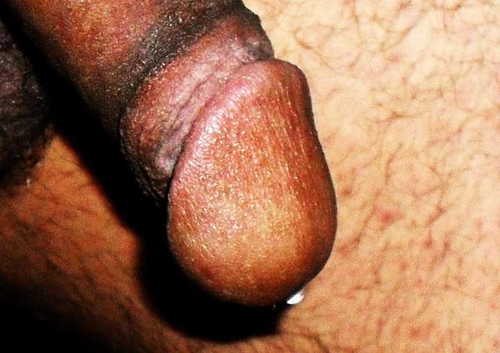 I like your dark circumcision scar