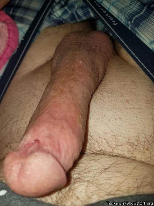 Very beautiful hypospadias
