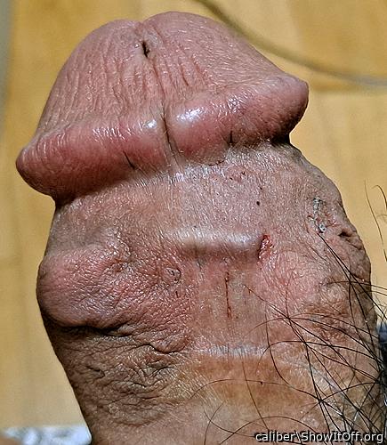 implant