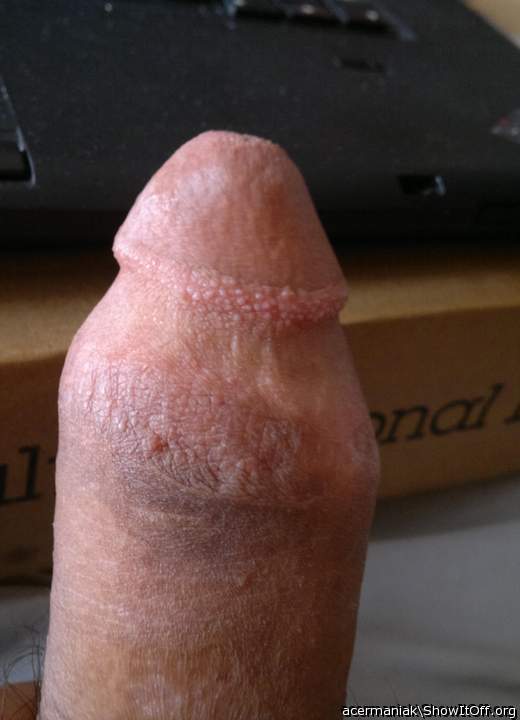 Did you get a circumcision? 