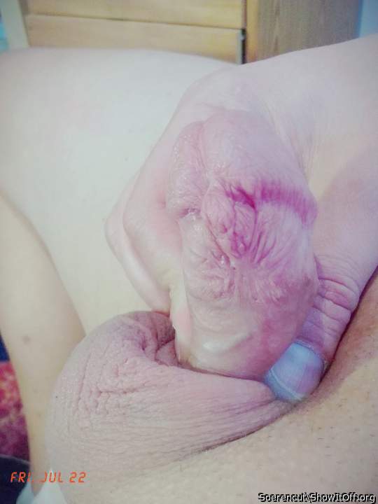 Frenu cut scar
