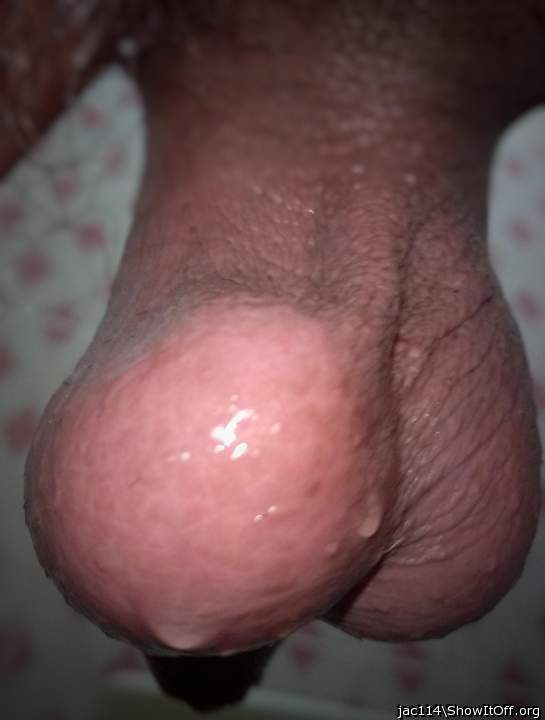 Swollen left testicle