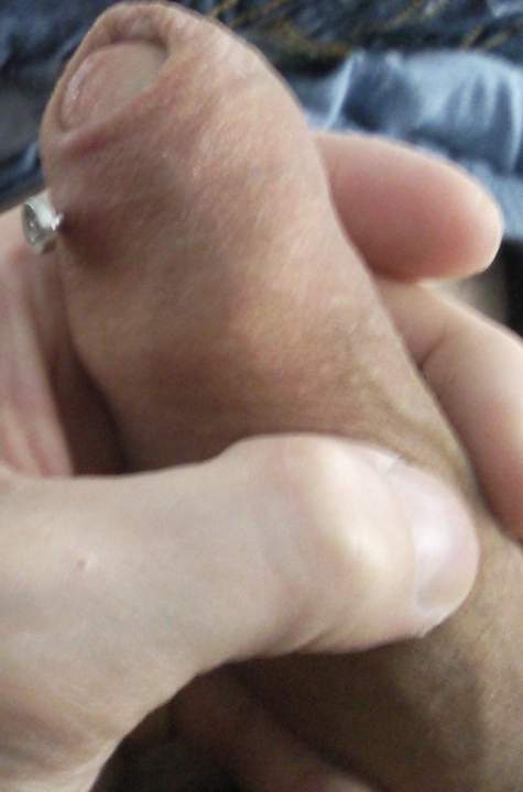A hole through my foreskin 1