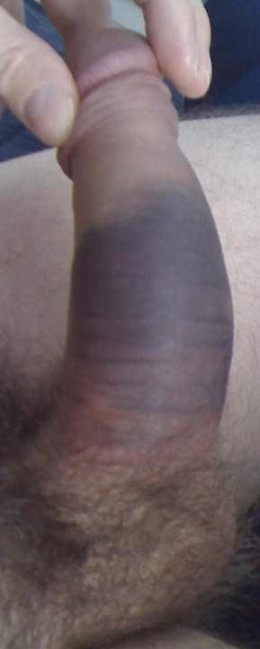 Snapped Penis