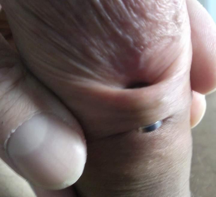 A hole through my foreskin 2