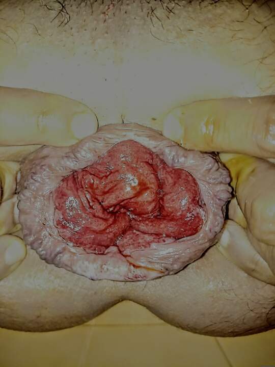 My prolapsed asshole