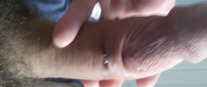A hole through my foreskin 3