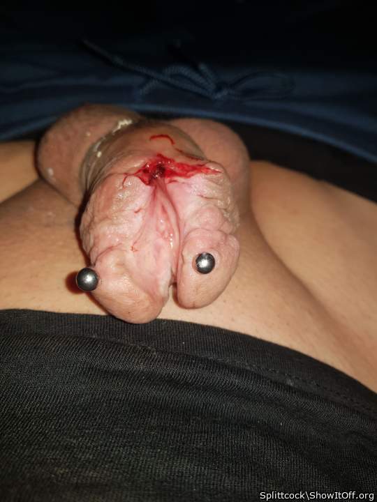 Photo of a penile from Splittcock