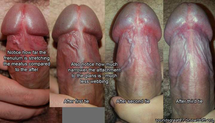 Change in my frenulum over three ties - erect underside