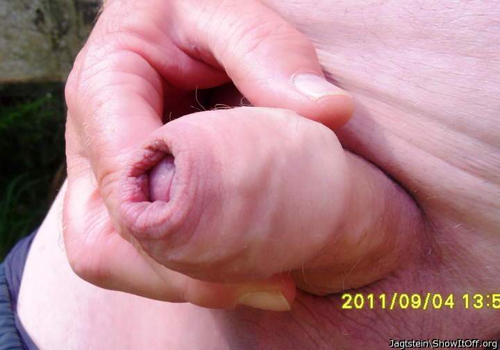 Foreskin closed