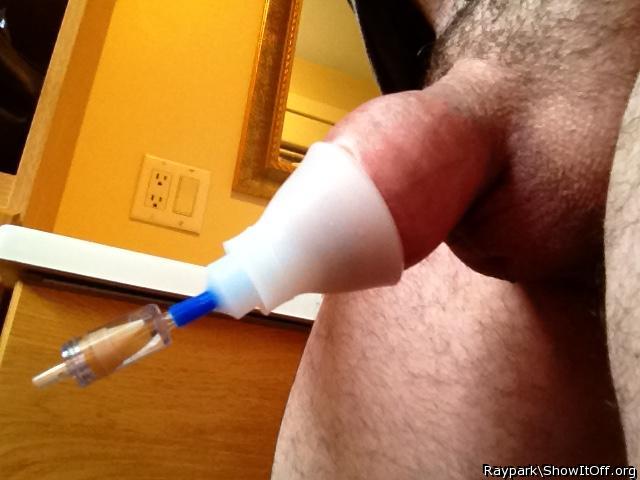 Restoring my foreskin
