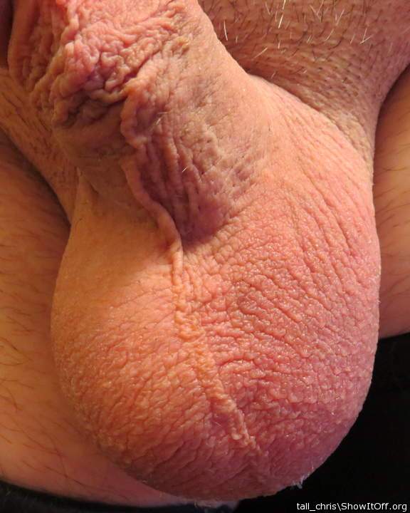My sac before the transscrotal