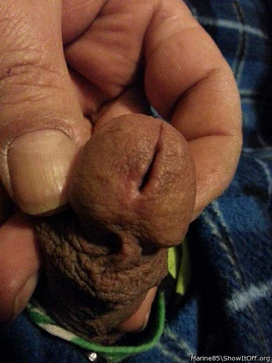 After first meatotomy cut healed