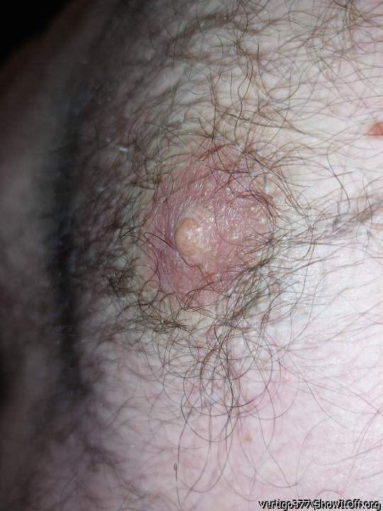 a male nipple