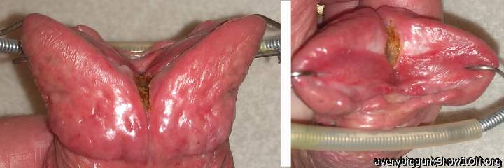 More Cautery