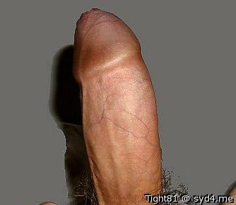 Phimosis
