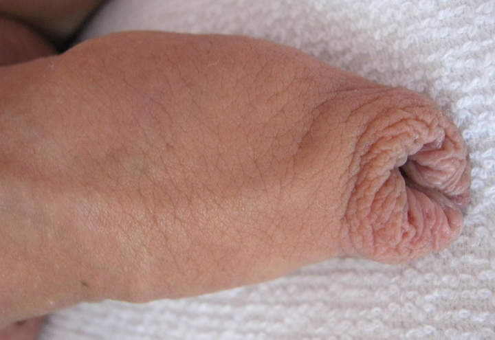 foreskin