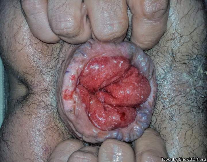 Prolapsed asshole