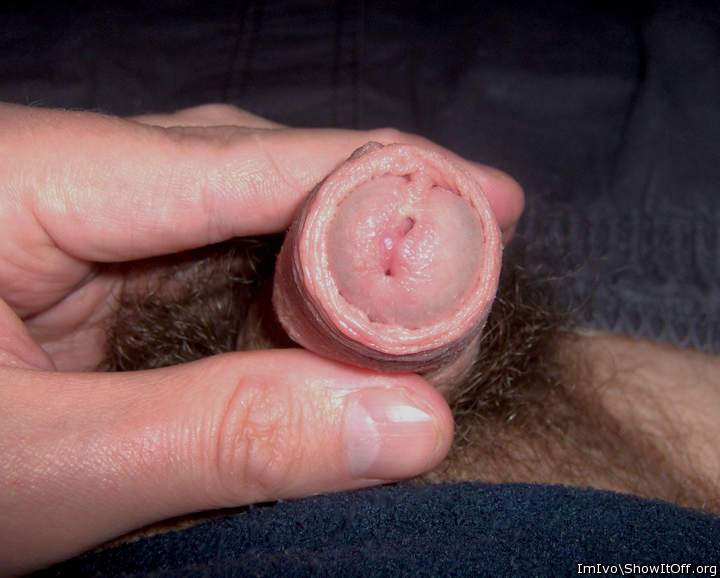 Partially nude glans with meatus