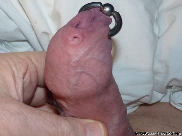 Infibulated Foreskin