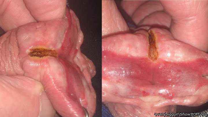 More Burning