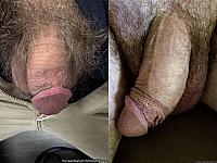 penile